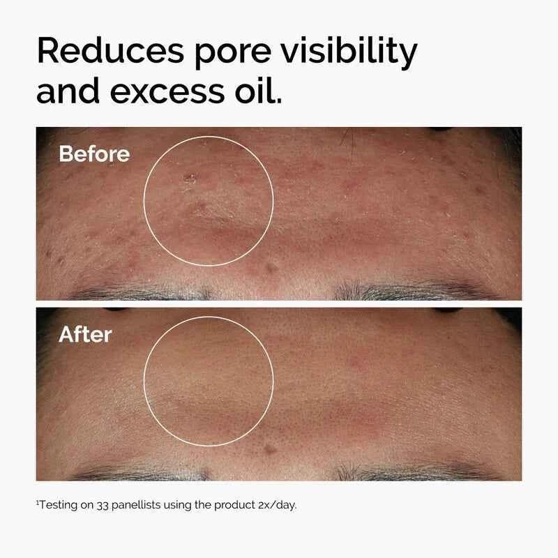 The Ordinary Niacinamide 10% + Zinc 1% – Pore Refining & Oil Control - Glow By Anie